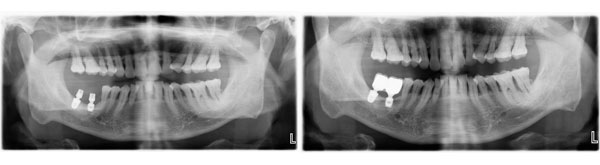 患者右下两颗后牙种植修复