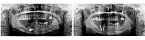患者右下四、五种植修复