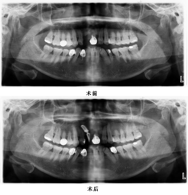 患者前牙HA涂层植体种植修复