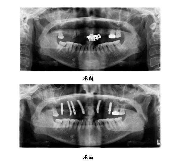 11 13 14 16 22 25种植修复 16至25烤瓷桥修