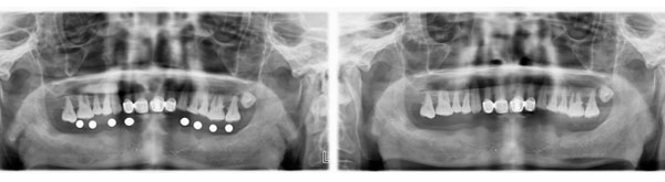 患者下半口多颗牙种植修复
