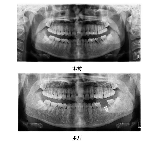 36拔除即刻种植义齿修复