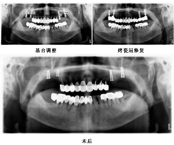 患者左右上颌四颗后牙种植修复